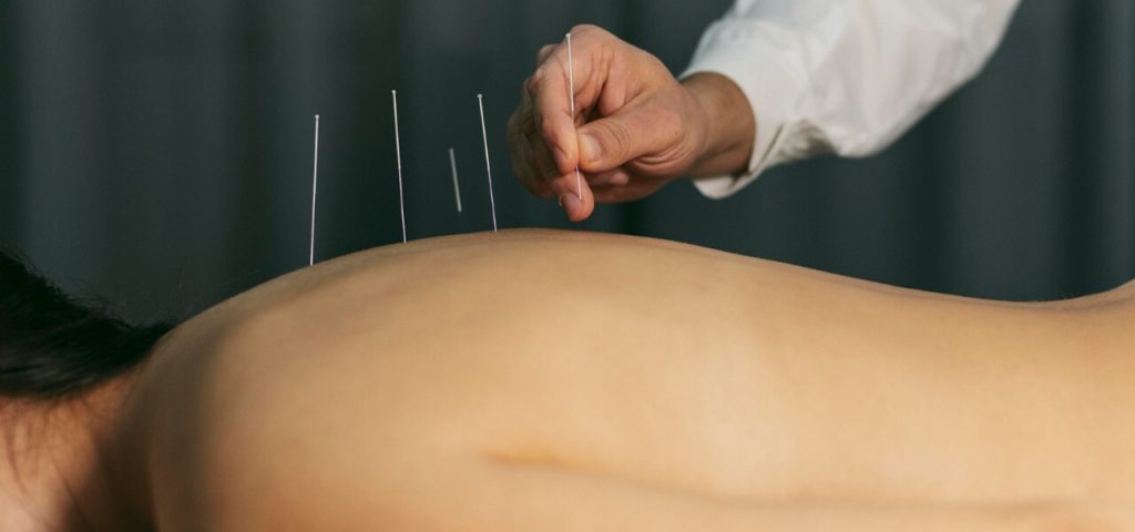 Acupuncture in Scottsdale