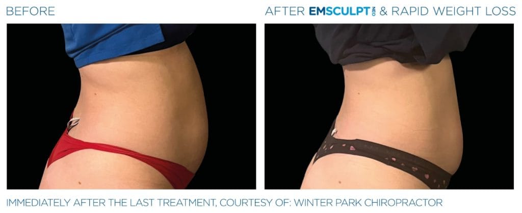 Best Emsculpt NEO in Scottsdale Before after