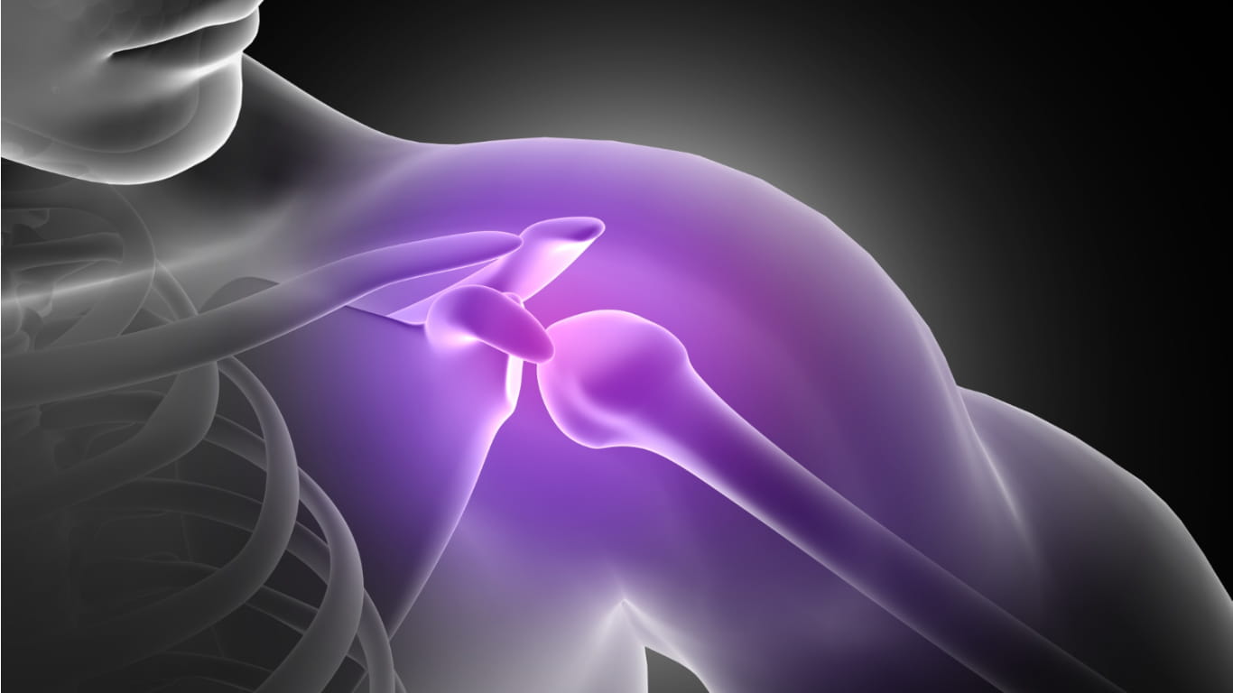 What Is Shoulder Impingement Syndrome?